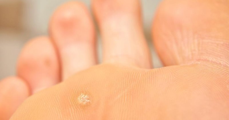 Nasır Nedir Neden Olur? Nasır, derinin sürekli baskıya