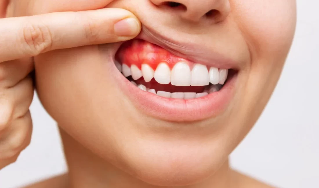 Diş Eti Çekilmesi Nedir Belirtileri Nelerdir? Diş eti çekilmesi, diş