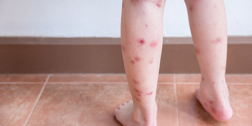 Kelebek hastalığı, tıbbi adıyla